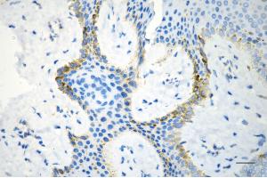 Immunohistochemistry was performed on paraffin-embedded human hemangioma using STAT5A antibody (ABIN7800347), 1:200). (Recombinant STAT5A antibody)