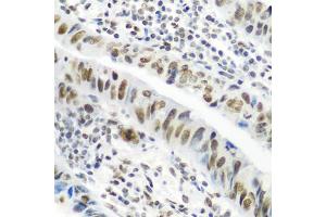 Immunohistochemistry of paraffin-embedded human colon carcinoma using CASP9 antibody (ABIN4903132) at dilution of 1:100 (40x lens).