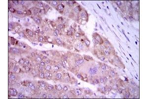 Immunohistochemical analysis of paraffin-embedded liver cancer tissues using NOS2 mouse mAb with DAB staining.