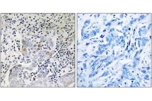 Immunohistochemistry analysis of paraffin-embedded human breast carcinoma tissue, using SESN1 Antibody. (SESN1 antibody  (AA 271-320))