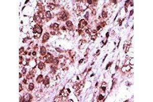 IHC analysis of FFPE human hepatocarcinoma tissue stained with the GSK3B antibody (GSK3 beta antibody  (AA 4-34))