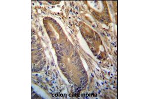 NETO2 Antibody (N-term ) (ABIN657245 and ABIN2846343) immunohistochemistry analysis in formalin fixed and paraffin embedded human colon carcinoma followed by peroxidase conjugation of the secondary antibody and DAB staining. (NETO2 antibody  (N-Term))