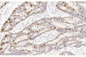 Immunohistochemistry (IHC) image for anti-Tumor Protein P53 (TP53) (AA 1-393) antibody (ABIN6242405)