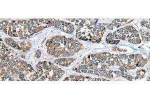 Immunohistochemistry of paraffin-embedded Human esophagus cancer tissue using CADM2 Polyclonal Antibody at dilution of 1:40(x200) (CADM2 antibody)