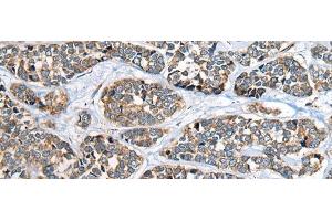 Immunohistochemistry of paraffin-embedded Human esophagus cancer tissue using CADM2 Polyclonal Antibody at dilution of 1:40(x200) (CADM2 antibody)