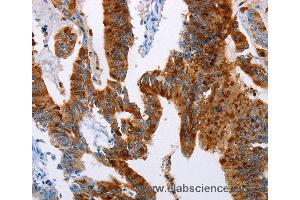 Immunohistochemistry of Human colon cancer using TFF3 Polyclonal Antibody at dilution of 1:50 (TFF3 antibody)