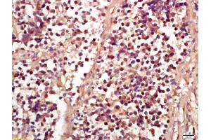 Formalin-fixed and paraffin embedded human lung carcinoma labeled with Anti-Phospho-RSK2 (Ser227) Polyclonal Antibody, Unconjugated (ABIN745268) at 1:200 followed by conjugation to the secondary antibody and DAB staining (RPS6KA3 antibody  (pSer227))