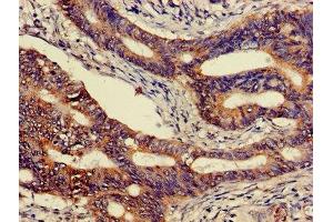 Immunohistochemistry of paraffin-embedded human colon cancer using ABIN7146807 at dilution of 1:100 (CEACAM7 antibody  (AA 36-242))