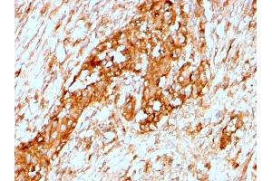 Formalin-fixed, paraffin-embedded human Breast stained with Alpha-1-Antitrypsin Recombinant Rabbit Monoclonal Antibody (AAT/3167R). (Recombinant SERPINA1 antibody)