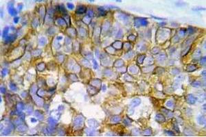 Immunohistochemistry (IHC) analyzes of p-Crk2 antibody in paraffin-embedded human lung adenocarcinoma tissue. (Crk antibody  (pTyr221))