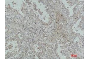 Immunohistochemical analysis of paraffin-embedded Human Lung Carcinoma using MICU1 Monoclonal Antibody. (MICU1 antibody)