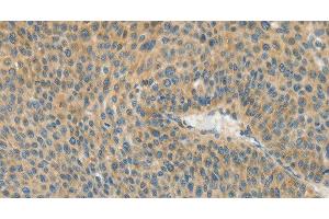 Immunohistochemistry of paraffin-embedded Human liver cancer using ASPA Polyclonal Antibody at dilution of 1:80 (ASPA antibody)