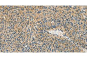 Immunohistochemistry of paraffin-embedded Human liver cancer using ASPA Polyclonal Antibody at dilution of 1:80