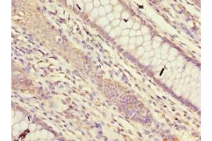 Immunohistochemistry of paraffin-embedded human colon cancer using ABIN7165410 at dilution of 1:100