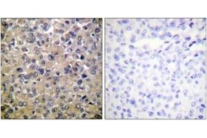 Immunohistochemistry analysis of paraffin-embedded human breast carcinoma tissue, using PP1-alpha (Ab-320) Antibody. (PPP1CA antibody  (AA 281-330))
