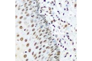 Immunohistochemical analysis of hnRNP R staining in human esophageal cancer formalin fixed paraffin embedded tissue section. (HNRNPR antibody)