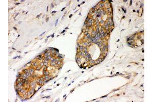 Anti- IKB alpha Picoband antibody, IHC(P) IHC(P): Human Mammary Cancer Tissue (NFKBIA antibody  (AA 3-112))