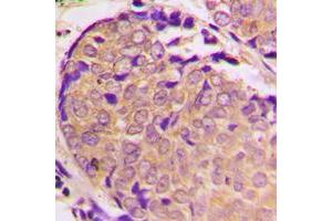 Immunohistochemical analysis of Alpha-synuclein (pS129) staining in human prostate cancer formalin fixed paraffin embedded tissue section. (SNCA antibody  (C-Term, pSer129))