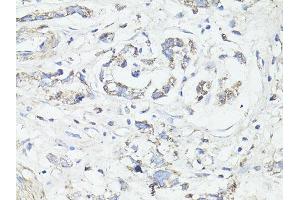 Immunohistochemistry of paraffin-embedded human gastric cancer using MAP1LC3B antibody (ABIN6291774) at dilution of 1:100 (40x lens).