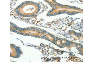 Immunohistochemistry of Human thyroid cancer using CAV3 Polyclonal Antibody at dilution of 1:40