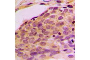 Immunohistochemical analysis of p116 Rip staining in human breast cancer formalin fixed paraffin embedded tissue section. (MPRIP antibody  (Center))