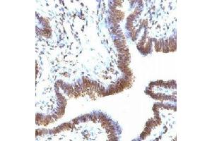IHC testing of FFPE human ovarian carcinoma and EMI-1 antibody (FBXP5). (FBXO5 antibody  (N-Term))