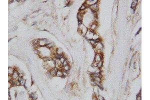 Anti-CDC42 antibody, IHC(P) IHC(P): Human Mammary Cancer Tissue (CDC42 antibody  (Middle Region))