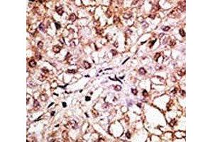 IHC analysis of FFPE human hepatocarcinoma tissue stained with the BNIP3L antibody (BNIP3L/NIX antibody  (AA 122-152))