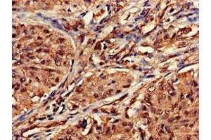 Immunohistochemistry of paraffin-embedded human lung cancer using ABIN7155530 at dilution of 1:100 (DOT1L antibody  (AA 331-484))
