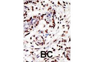 Formalin-fixed and paraffin-embedded human cancer tissue reacted with the MLL polyclonal antibody  , which was peroxidase-conjugated to the secondary antibody, followed by AEC staining. (MLL/KMT2A antibody  (AA 312-343))