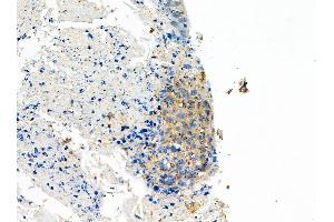 ABIN6258856 and ABIN6275099 at 1/100 staining Human pancreatic cancer by IHC-P. (INSL4 antibody  (Internal Region))