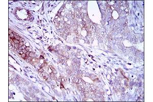 Immunohistochemical analysis of paraffin-embedded cervical cancer tissues using ZEB1 mouse mAb with DAB staining.