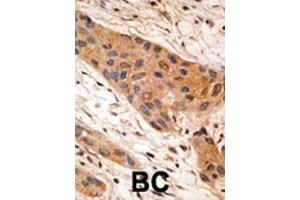 Formalin-fixed and paraffin-embedded human cancer tissue reacted with the primary antibody, which was peroxidase-conjugated to the secondary antibody, followed by AEC staining. (BNIP1 antibody  (AA 92-127))