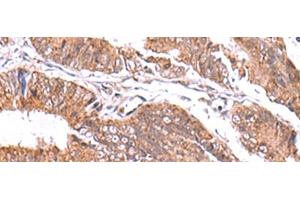Immunohistochemistry of paraffin-embedded Human colorectal cancer tissue using GATM Polyclonal Antibody at dilution of 1:70(x200) (GATM antibody)