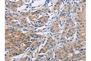The image on the left is immunohistochemistry of paraffin-embedded Human lung cancer tissue using ABIN7128287(AGBL5 Antibody) at dilution 1/30, on the right is treated with fusion protein. (AGBL5 antibody)