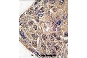 Formalin-fixed and paraffin-embedded human lung carcinoma tissue reacted with YARS antibody (C-term) (ABIN391839 and ABIN2841678) , which was peroxidase-conjugated to the secondary antibody, followed by DAB staining. (YARS antibody  (C-Term))