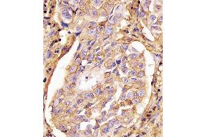 (ABIN659120 and ABIN2843760) staining CD44 in human lung adenocarcinoma tissue sections by Immunohistochemistry (IHC-P - paraformaldehyde-fixed, paraffin-embedded sections). (CD44 antibody)