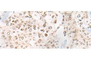 Immunohistochemistry of paraffin-embedded Human prost ate cancer tissue using CEP72 Polyclonal Antibody at dilution of 1:40(x200) (CEP72 antibody)