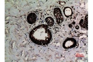 Immunohistochemistry (IHC) analysis of paraffin-embedded Human Breast Cancer, antibody was diluted at 1:100. (Histone 3 antibody  (2meLys10))