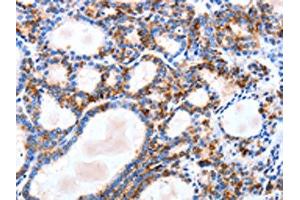 The image on the left is immunohistochemistry of paraffin-embedded Human thyroid cancer tissue using ABIN7129823(IGSF6 Antibody) at dilution 1/10, on the right is treated with fusion protein. (IGSF6 antibody)