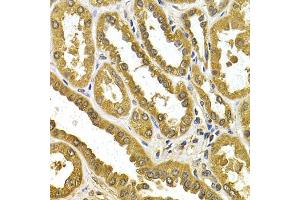 Immunohistochemistry of paraffin-embedded human kidney cancer using μgT1A4 antibody (ABIN5973231) at dilution of 1/200 (40x lens).