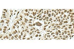 Immunohistochemistry of paraffin-embedded Human esophagus cancer tissue using KHSRP Polyclonal Antibody at dilution of 1:50(x200) (KHSRP antibody)