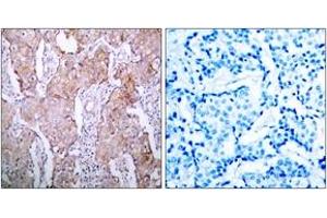 Immunohistochemistry analysis of paraffin-embedded human breast carcinoma, using EGFR (Phospho-Ser1070) Antibody. (EGFR antibody  (pSer1070))