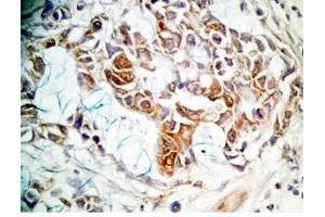 Human stomach cancer tissue was stained by rabbit anti-Spexin(H) Antiserum (Spexin antibody)