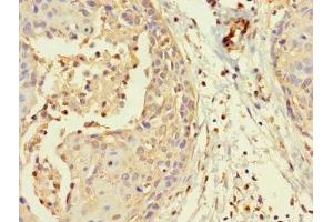 Immunohistochemistry of paraffin-embedded human cervical cancer using ABIN7160194 at dilution of 1:100 (MORC1 antibody  (AA 683-984))