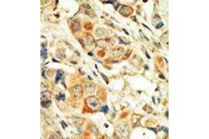 Formalin-fixed and paraffin-embedded human cancer tissue reacted with the primary antibody, which was peroxidase-conjugated to the secondary antibody, followed by DAB staining. (PKC alpha antibody  (C-Term))