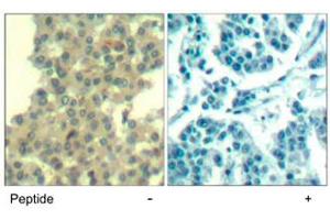 Immunohistochemical analysis of paraffin-embedded human breast carcinoma tissue using ERBB3 polyclonal antibody . (ERBB3 antibody  (Tyr1328))