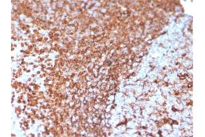 Formalin-fixed, paraffin-embedded human Prostate Carcinoma stained with Vimentin Mouse Monoclonal Antibody (VIM/3736). (Vimentin antibody  (AA 2-466))