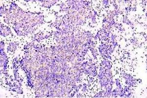 Immunohistochemistry (IHC) analysis of PRKAA1 antibody in paraffin-embedded human lung adenocarcinoma tissue. (PRKAA1 antibody)