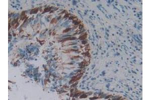 IHC-P analysis of Human Lung Cancer Tissue, with DAB staining. (PD-1 antibody  (AA 41-132))